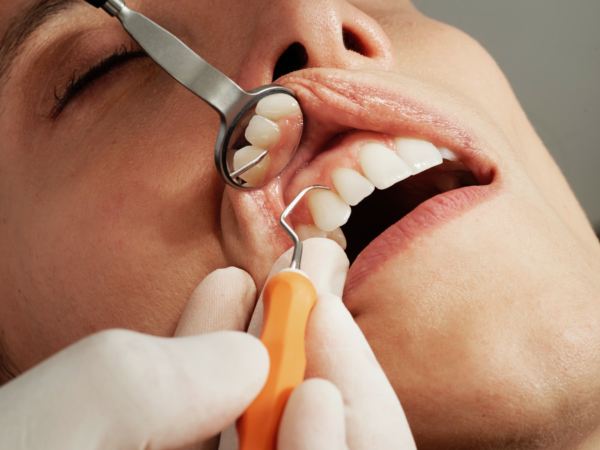 Huller i tænderne – Sådan undgår man effektivt huller i tænderne